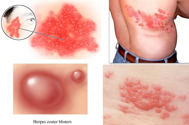 Bệnh zona là gì? Bệnh zona là gì?