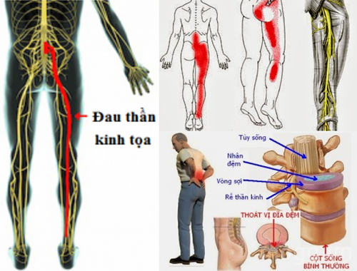 Đau thần kinh tọa là gì? Đau thần kinh tọa là gì?